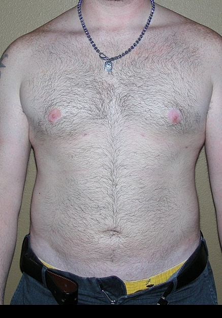 Vaser Liposelection Before & After