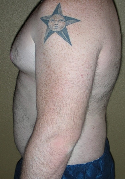 Vaser Liposelection Before & After