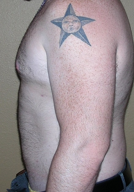 Vaser Liposelection Before & After