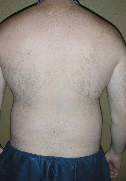 Vaser Liposelection Before & After