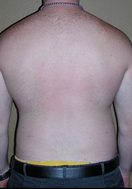 Vaser Liposelection Before & After