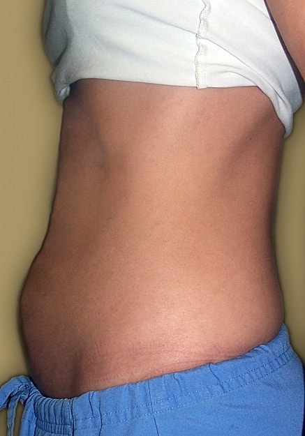 Vaser Liposelection Before & After