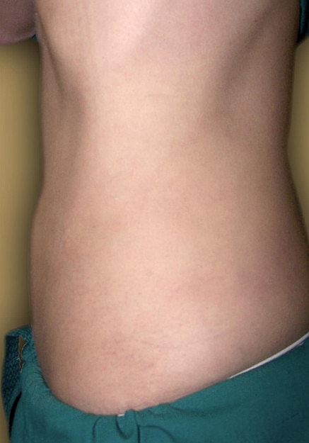 Vaser Liposelection Before & After