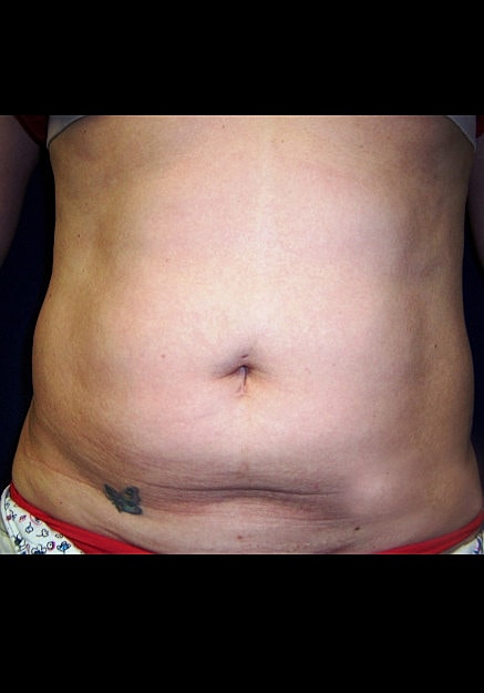 Vaser Liposelection Before & After