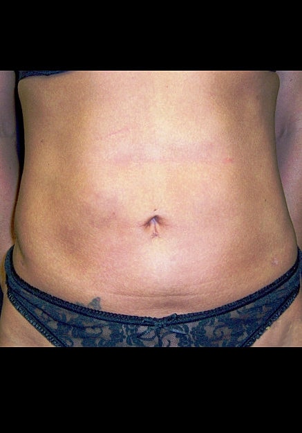 Vaser Liposelection Before & After
