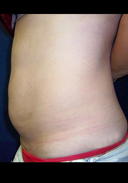 Vaser Liposelection Before & After