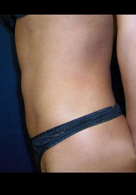 Vaser Liposelection Before & After