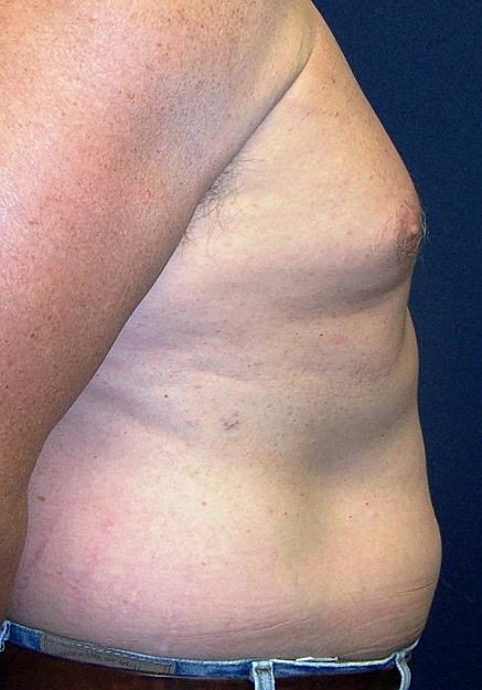 Vaser Liposelection Before & After