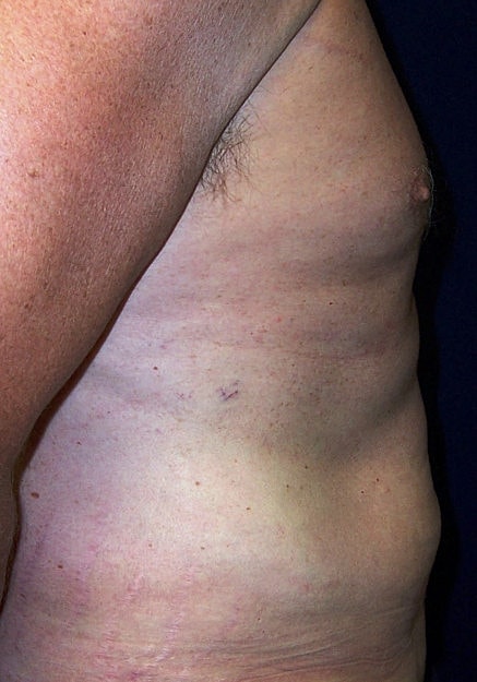 Vaser Liposelection Before & After