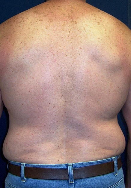 Vaser Liposelection Before & After