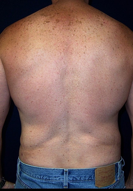 Vaser Liposelection Before & After