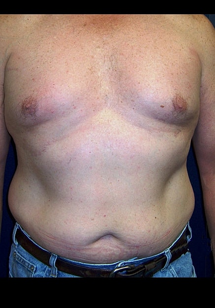 Vaser Liposelection Before & After