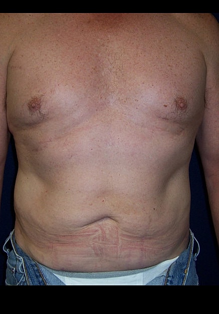 Vaser Liposelection Before & After