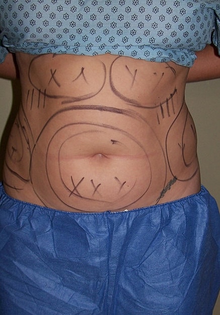 Vaser Liposelection Before & After