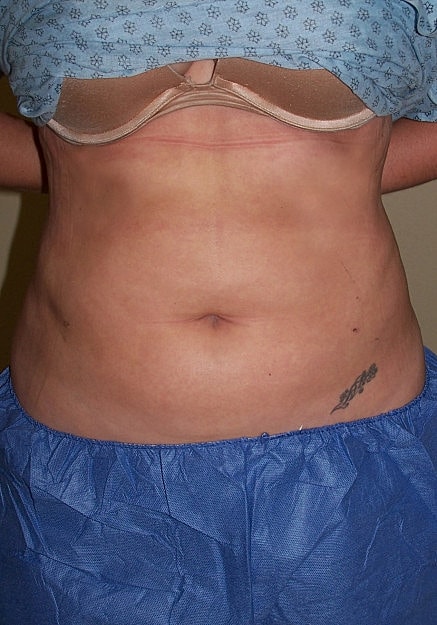 Vaser Liposelection Before & After
