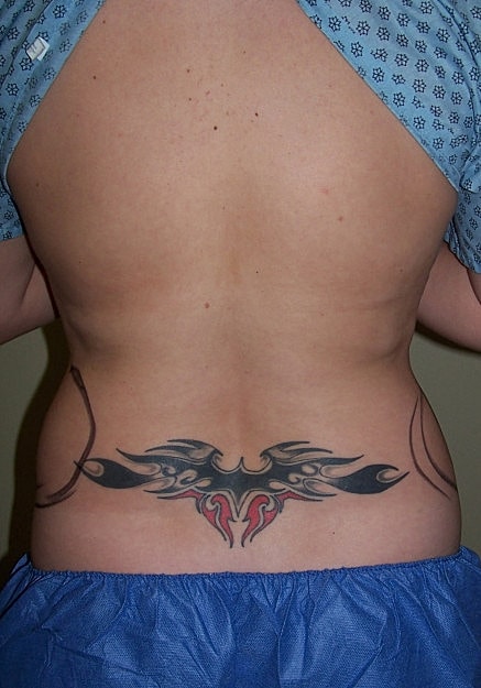 Vaser Liposelection Before & After