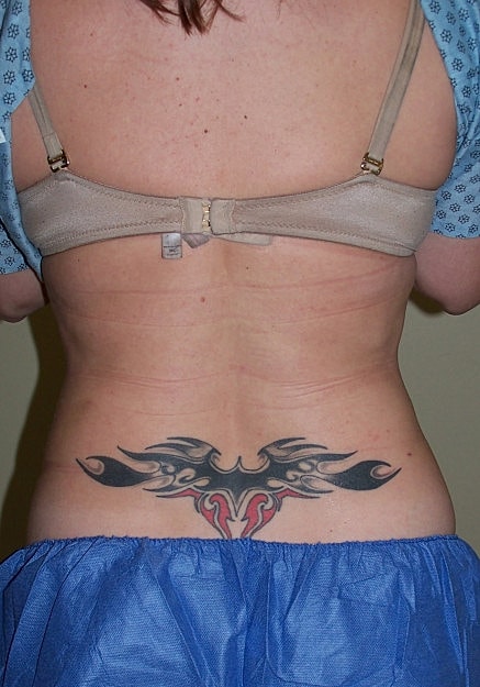 Vaser Liposelection Before & After