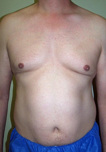 Vaser Liposelection Before & After