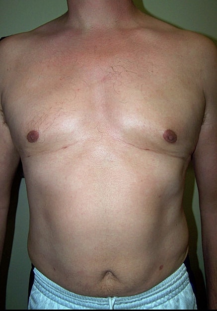 Vaser Liposelection Before & After