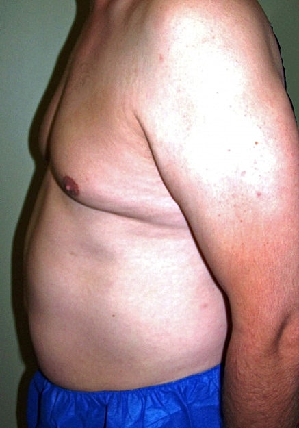 Vaser Liposelection Before & After
