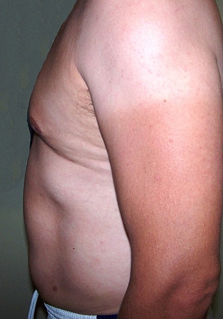Vaser Liposelection Before & After