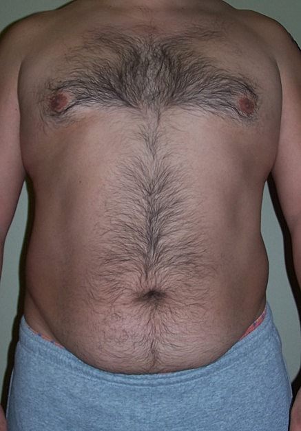 Vaser Liposelection Before & After