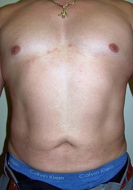 Vaser Liposelection Before & After