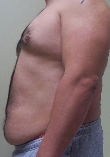 Vaser Liposelection Before & After