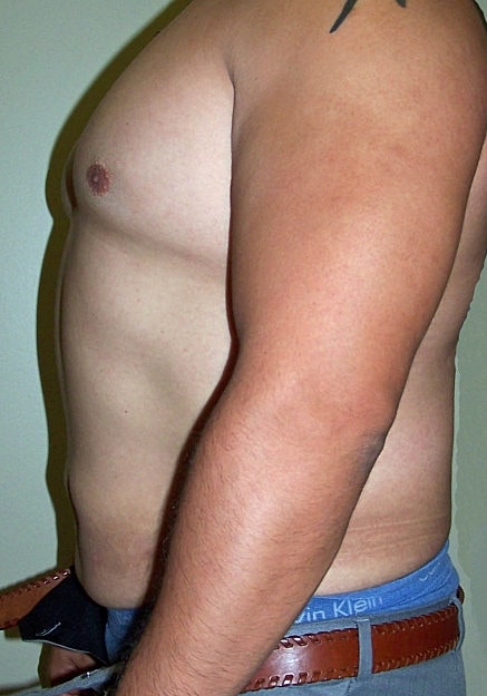 Vaser Liposelection Before & After