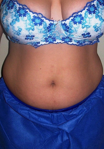 Vaser Liposelection Before & After