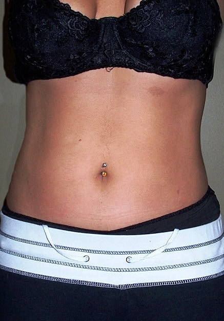 Vaser Liposelection Before & After