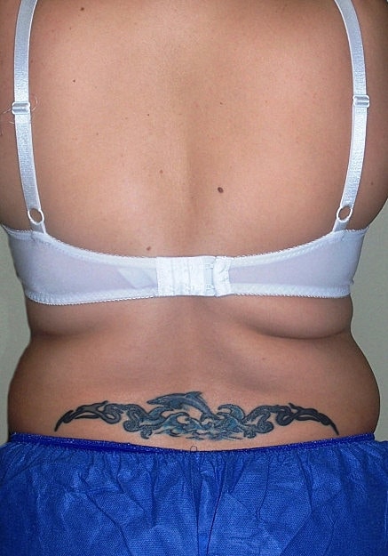 Vaser Liposelection Before & After