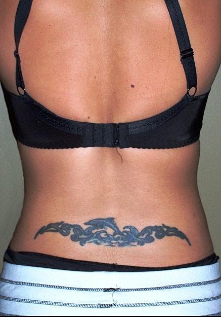 Vaser Liposelection Before & After