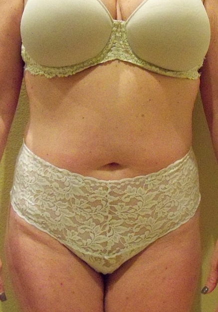 Vaser Liposelection Before & After
