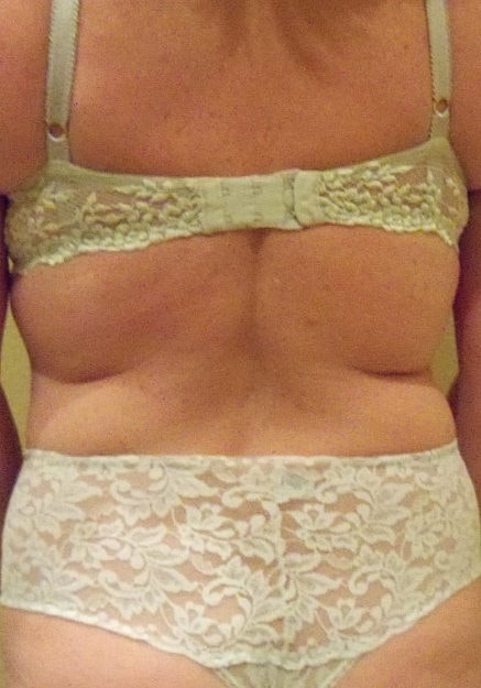 Vaser Liposelection Before & After