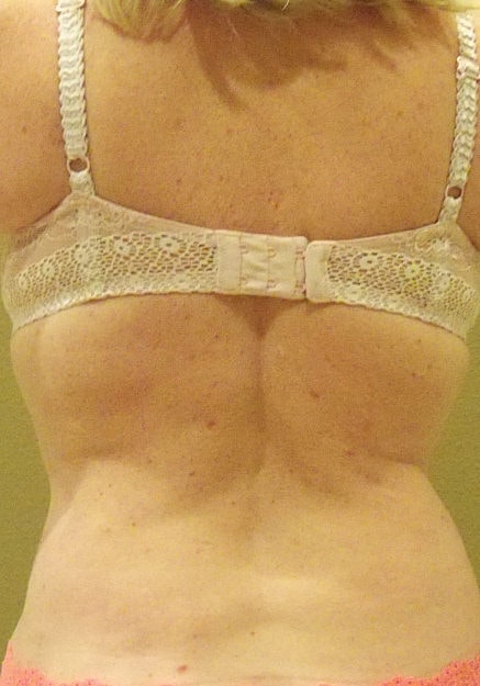 Vaser Liposelection Before & After