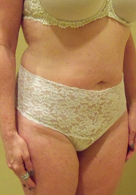 Vaser Liposelection Before & After
