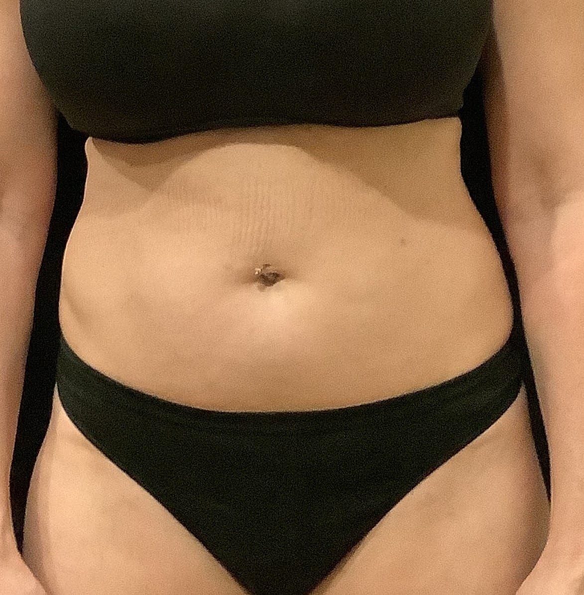 Vaser Liposelection Before & After