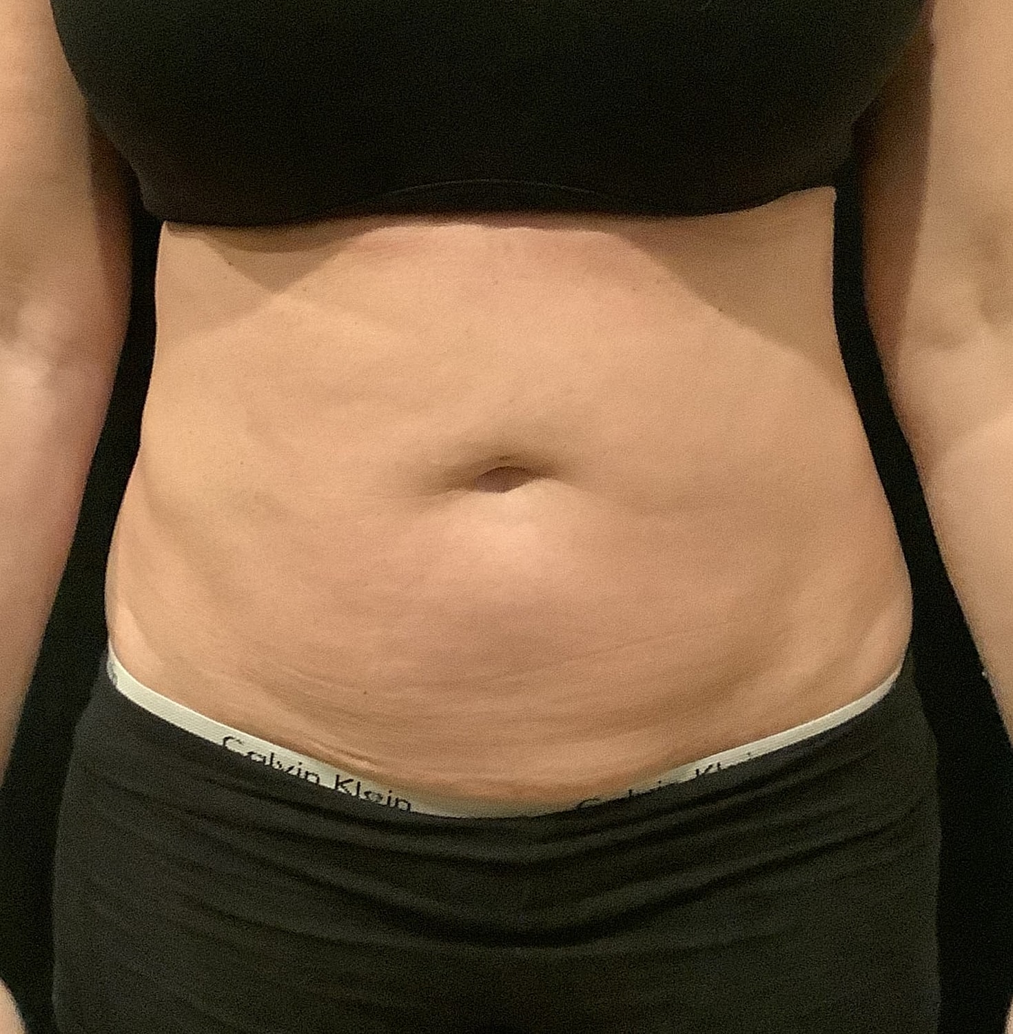 Vaser Liposelection Before & After