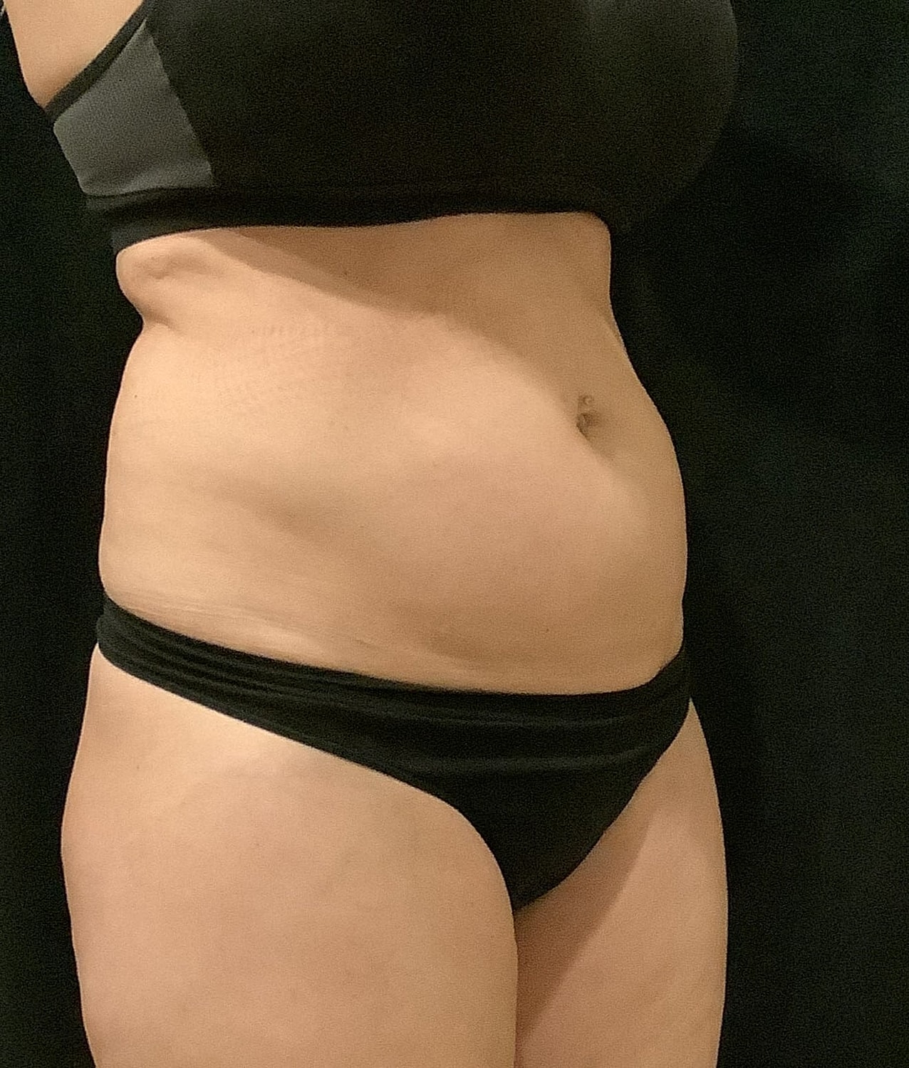 Vaser Liposelection Before & After