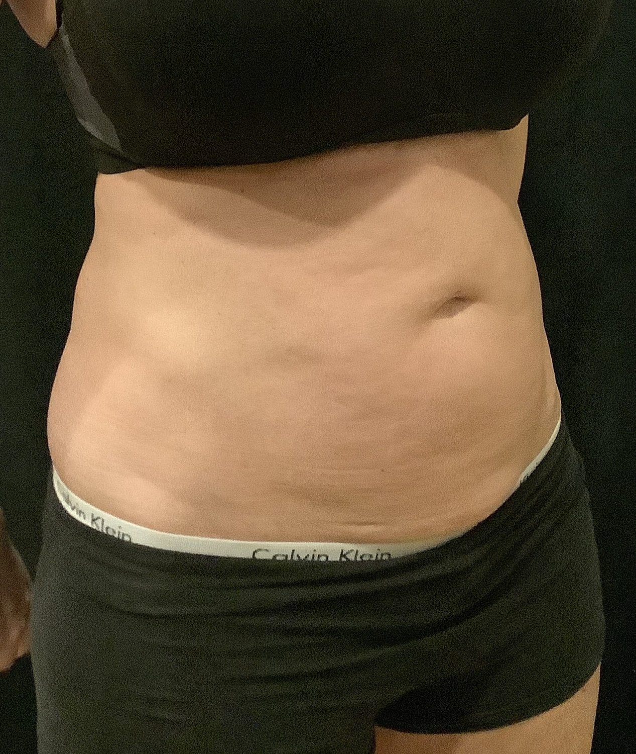 Vaser Liposelection Before & After