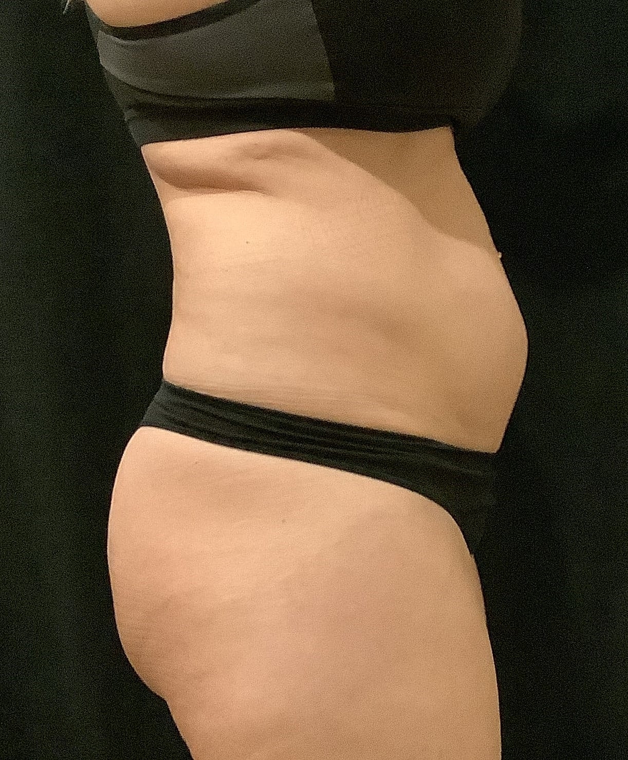 Vaser Liposelection Before & After