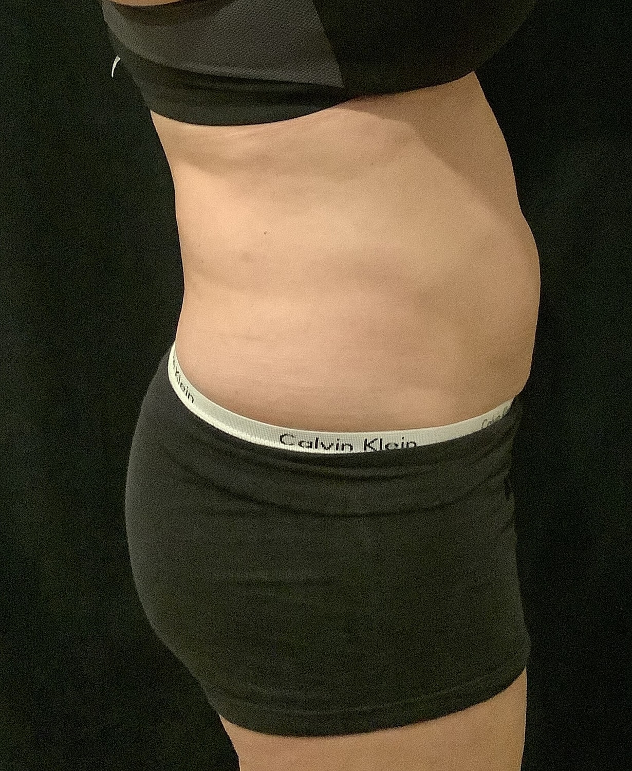 Vaser Liposelection Before & After