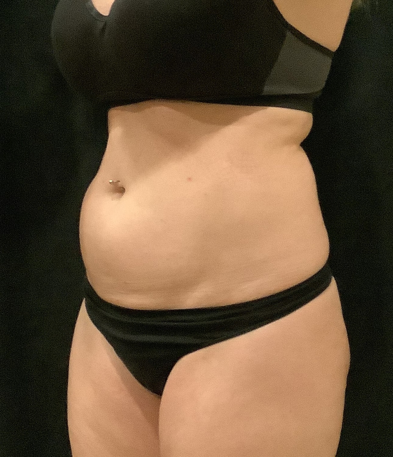 Vaser Liposelection Before & After