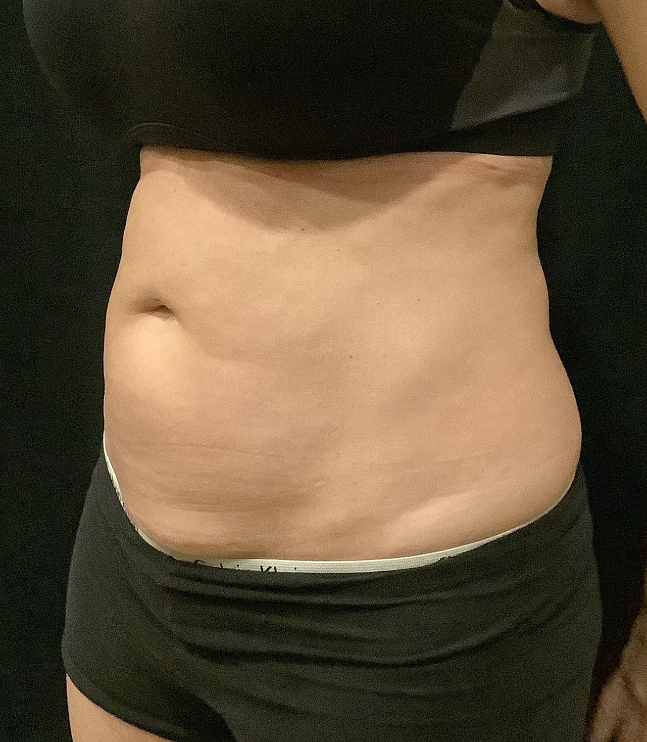 Vaser Liposelection Before & After