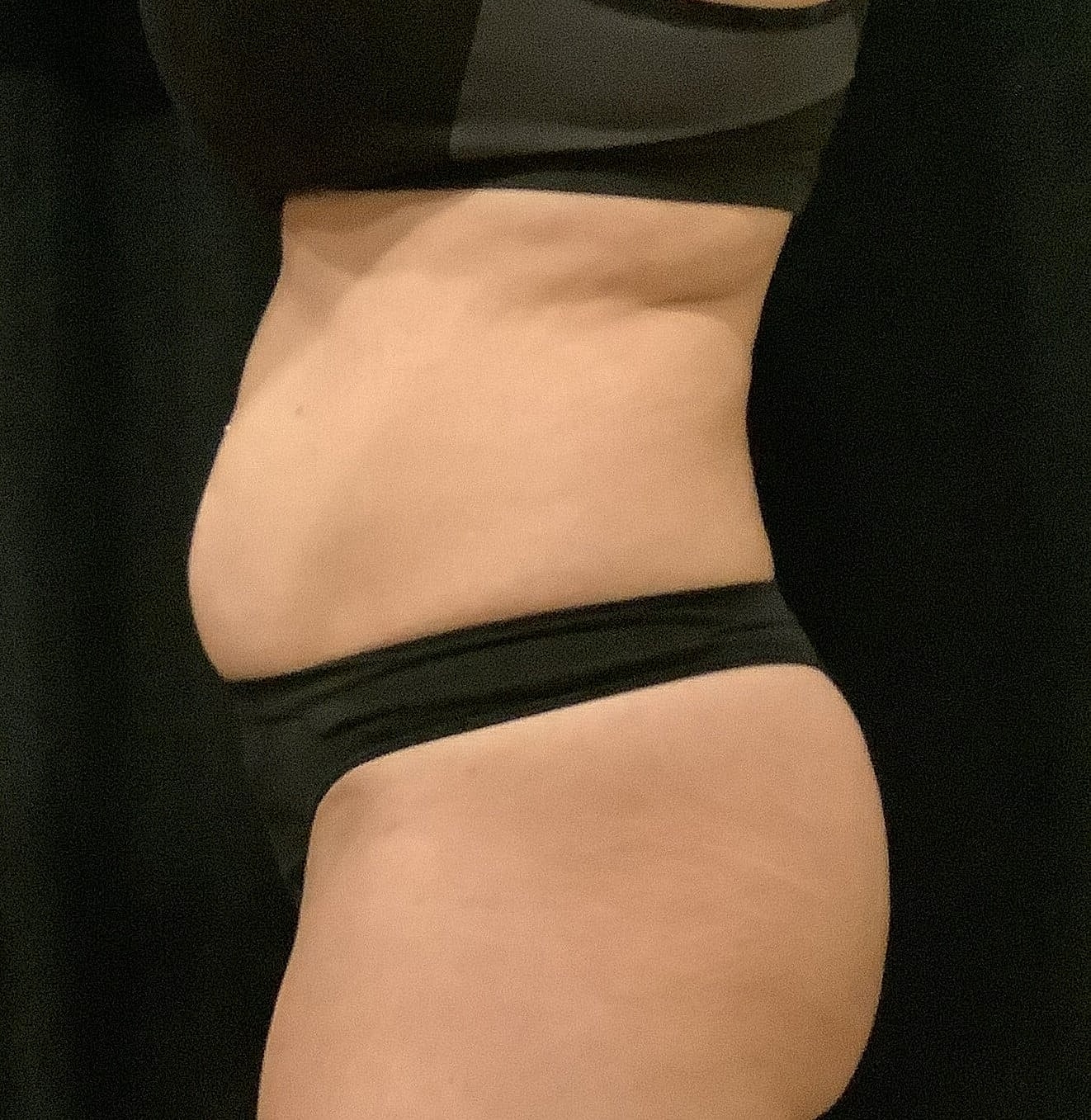 Vaser Liposelection Before & After