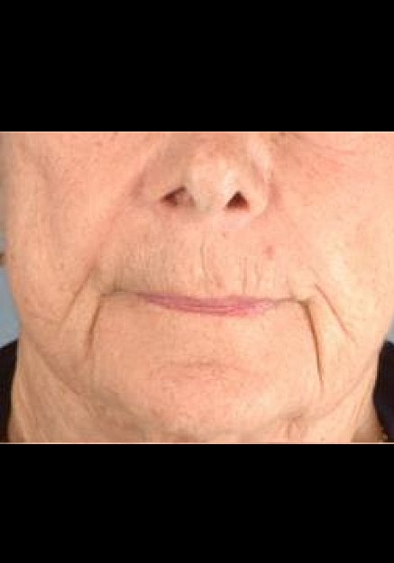 Radiesse Before & After