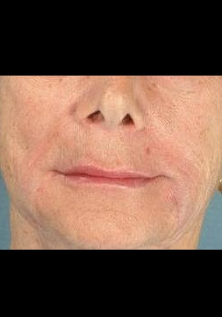 Radiesse Before & After