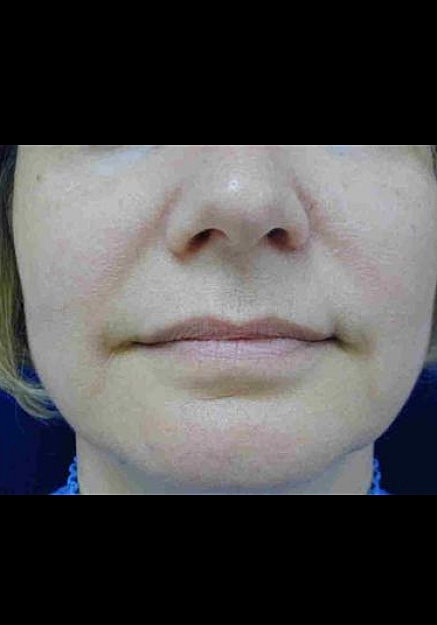 Radiesse Before & After
