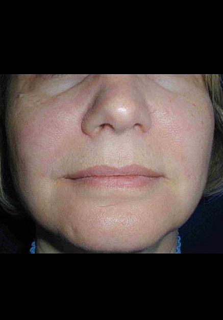 Radiesse Before & After